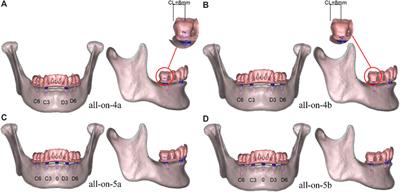 Biomechanical comparison of all-on-4 and all-on-5 implant-supported prostheses with alteration of anterior-posterior spread: a three-dimensional finite element analysis